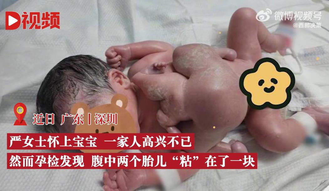 深圳一男婴出生时四手四脚 医生惊叹：寄生胎没头和心脏 发生概率50万分之一